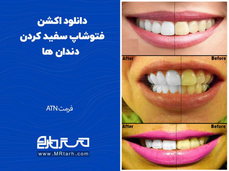 دانلود-اکشن-فتوشاپ-سفید-کردن-دندان-ها